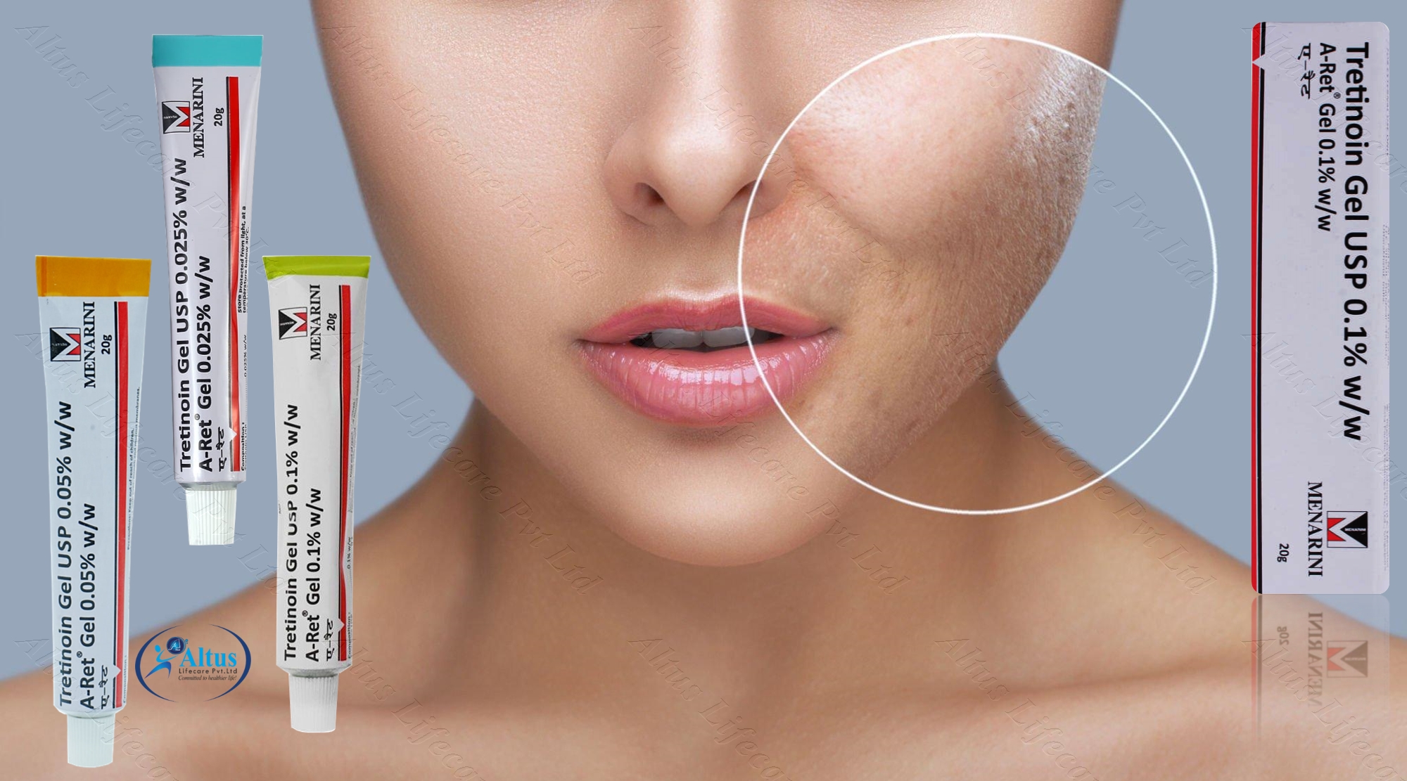 Tretinoin Cream: Your Ultimate Guide to Flawless Complexion