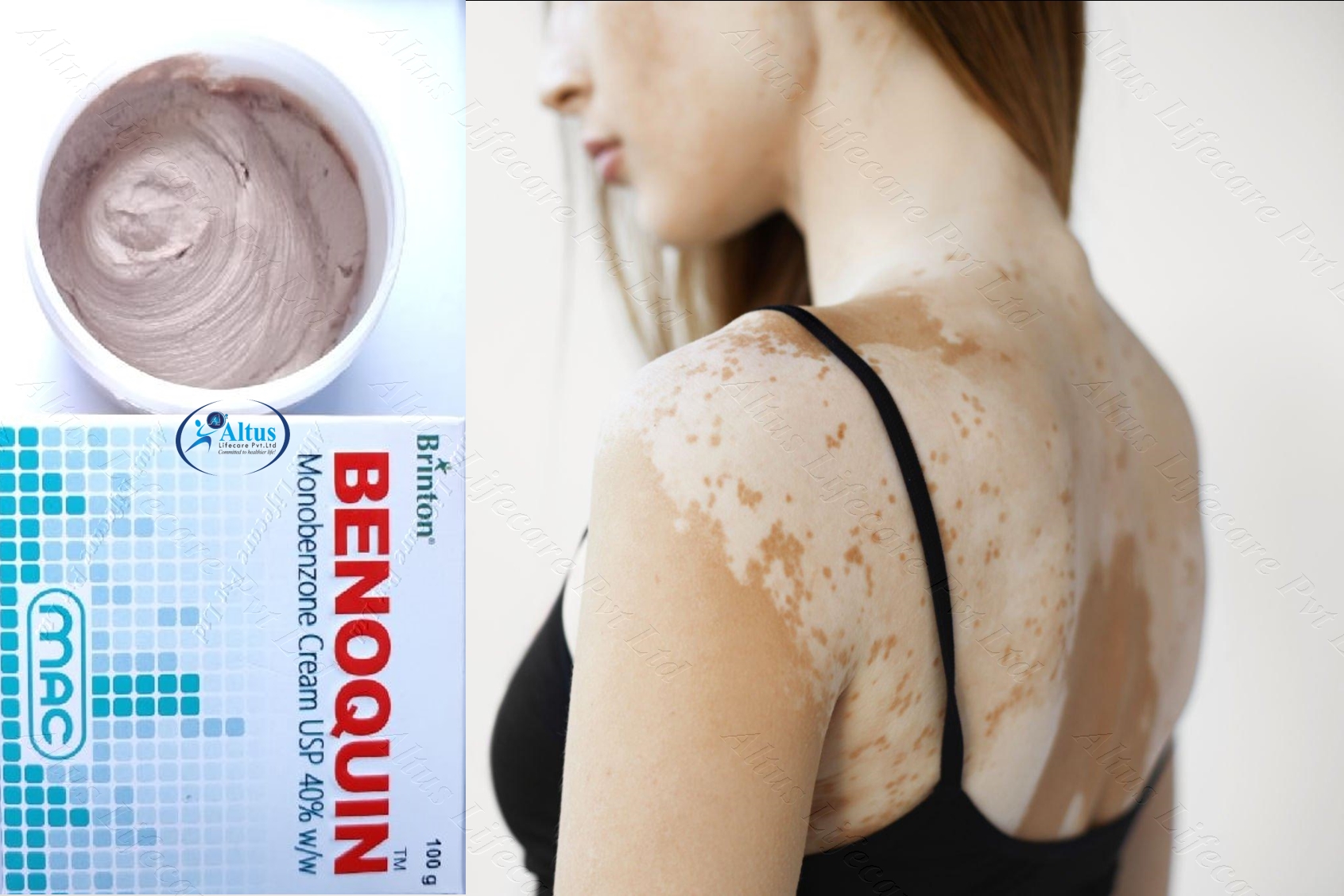 Benoquin Cream: The Ultimate Solution for Even-Toned Skin You've Been Waiting For!