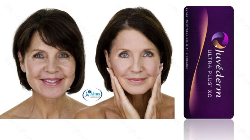 Juvederm Ultra XC Injection 1 1