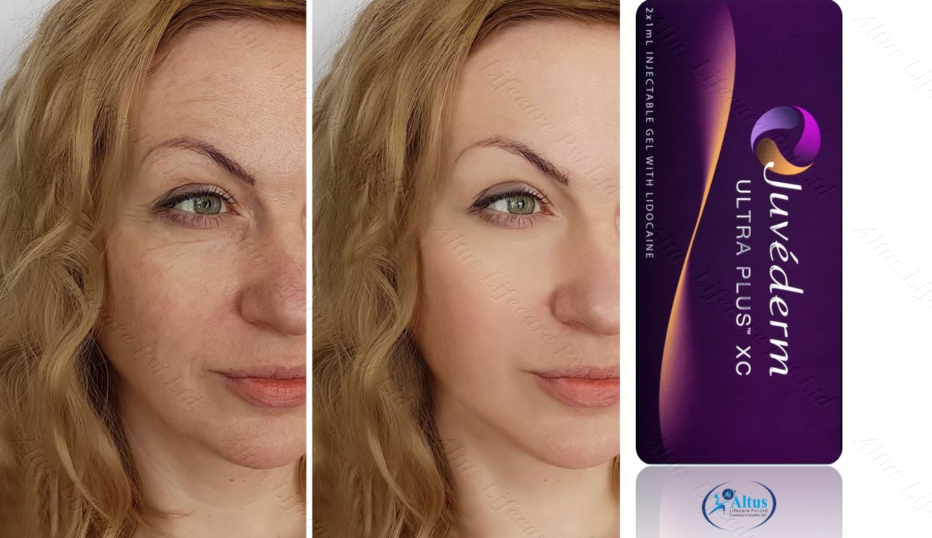 Insta-Ready Skin: How Juvederm Ultra Plus XC Is Taking Over Beauty Trends