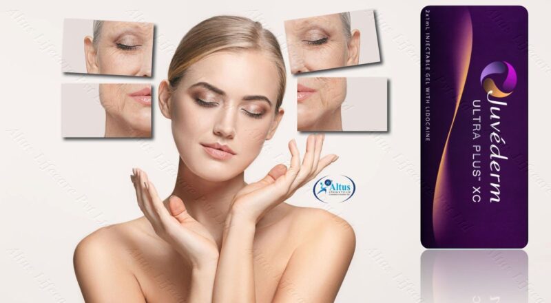 Juvederm Ultra XC Injection 3