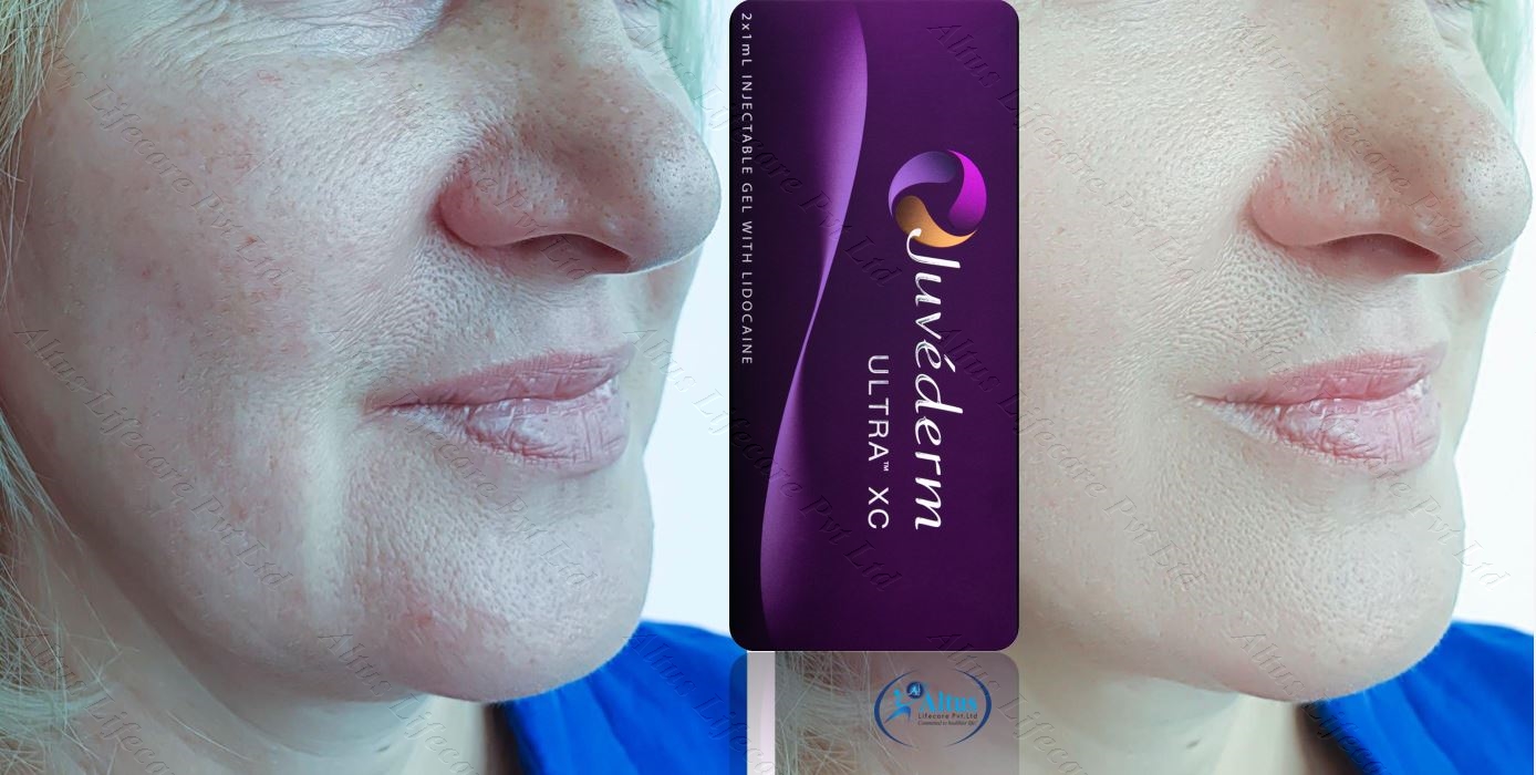 Say Goodbye to Wrinkles: Juvederm Ultra XC Injection Benefits Revealed