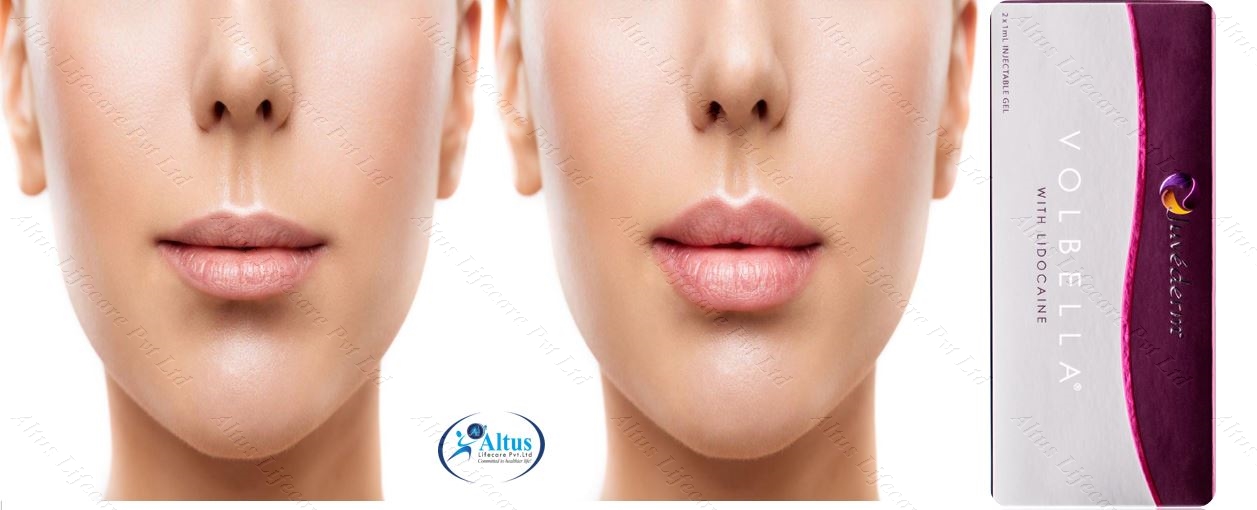 Juvederm Volbella Injection 21